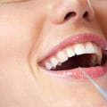 Are teeth cleaning free?