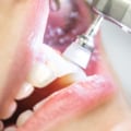 What happens if you don't do teeth cleaning?