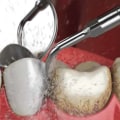 What does teeth cleaning cost?