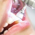 Why teeth cleaning hurt?