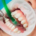 How long does a dental deep cleaning take?