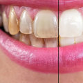 Will teeth cleaning remove stains?