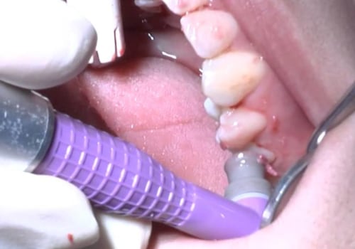 What does deep cleaning of teeth include?