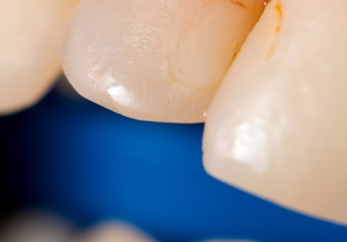 Does teeth cleaning damage enamel?