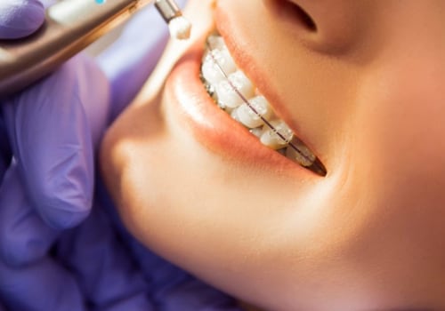 When is teeth cleaning necessary?