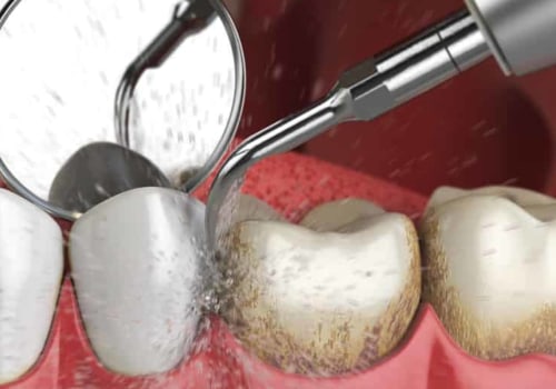 What does teeth cleaning cost?