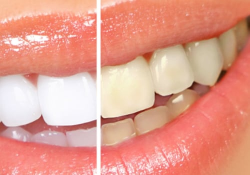 Will teeth cleaning whiten teeth?