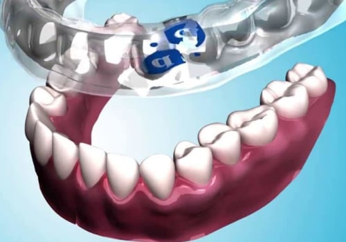 Is there an alternative to deep cleaning teeth?